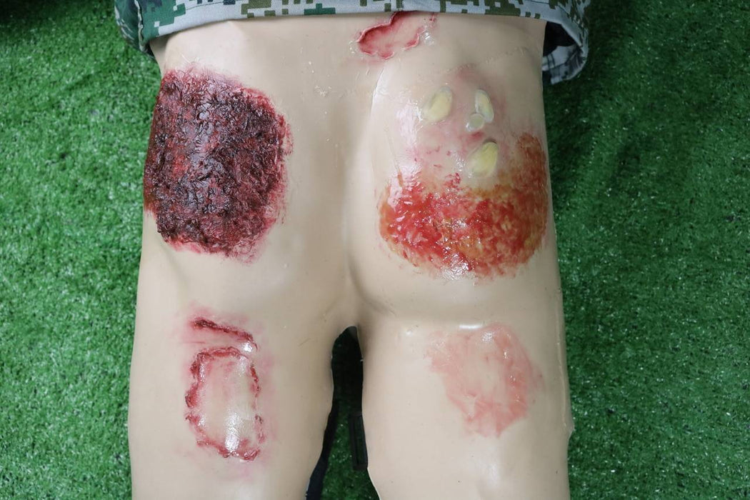 Anatomy Lab Moulage - Buttock Burn Injury
