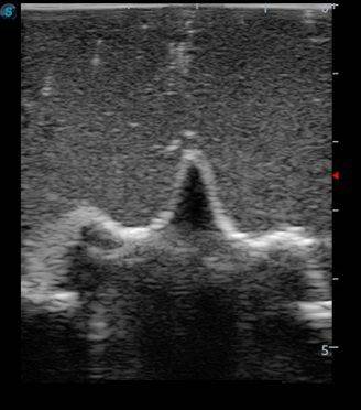 Anatomy Lab Pediatric Lumbar Puncture Ultrasound Training  Model