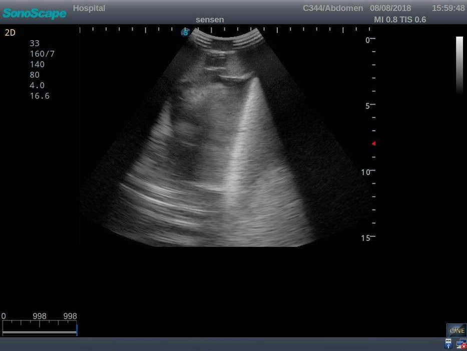 Anatomy Lab Pneumothorax and Thoracic Closed Drainage Ultrasound Training Model