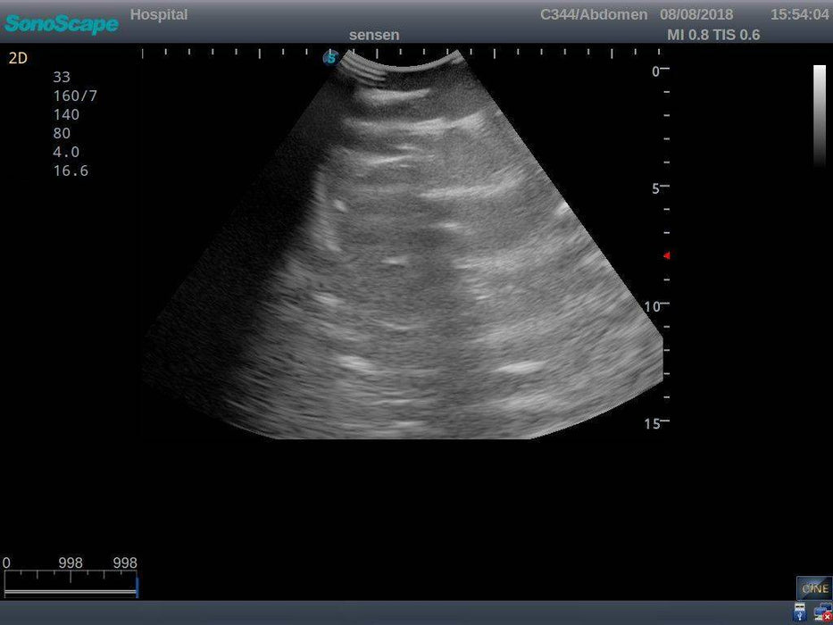 Anatomy Lab Pneumothorax and Thoracic Closed Drainage Ultrasound Training Model