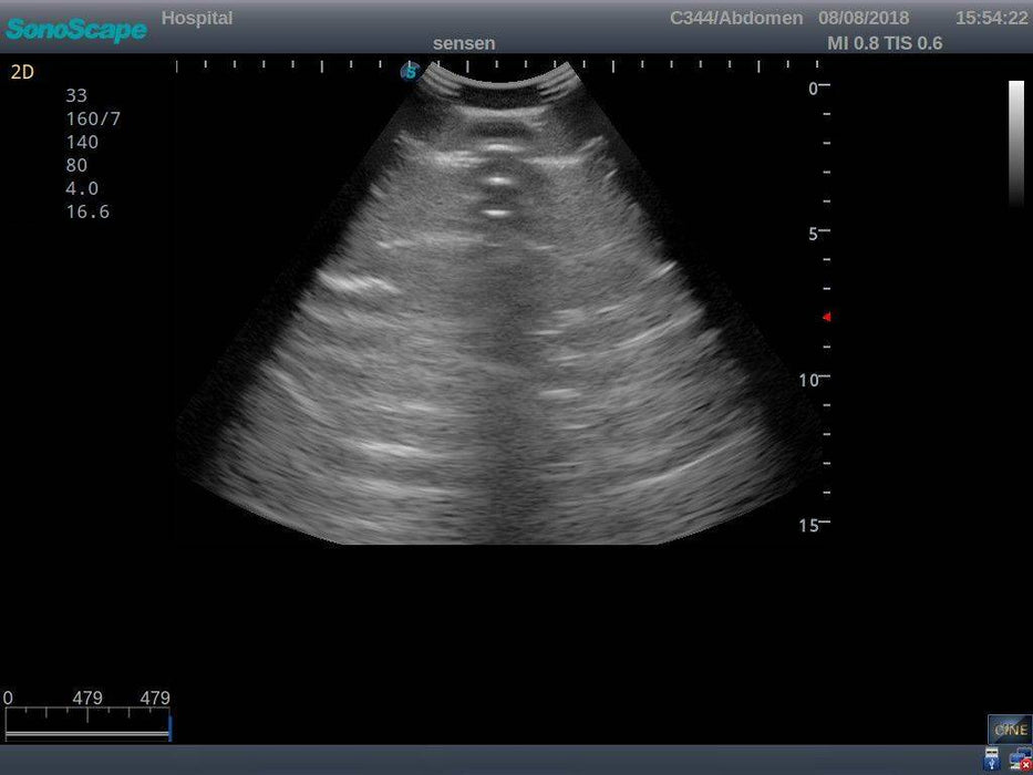 Anatomy Lab Pneumothorax and Thoracic Closed Drainage Ultrasound Training Model