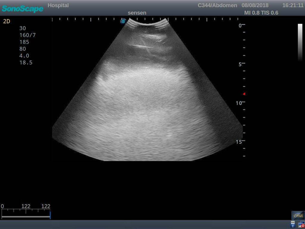 Anatomy Lab Thoracentesis Ultrasound Training Model — Pristine Medical