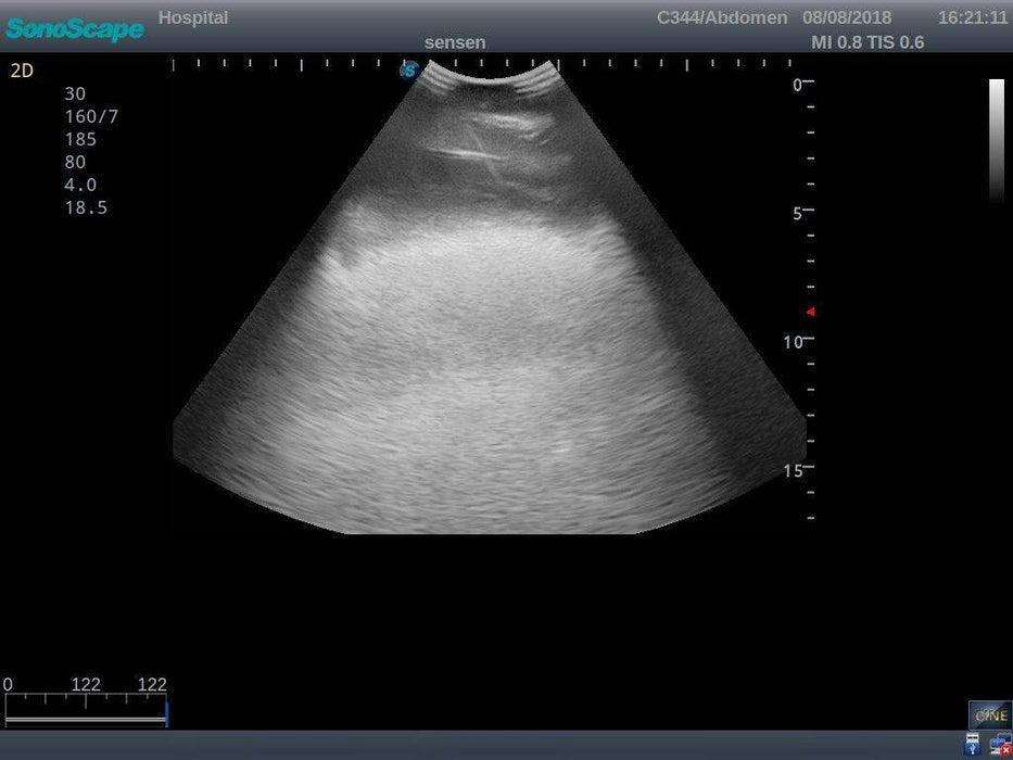 Anatomy Lab Thoracentesis Ultrasound Training  Model